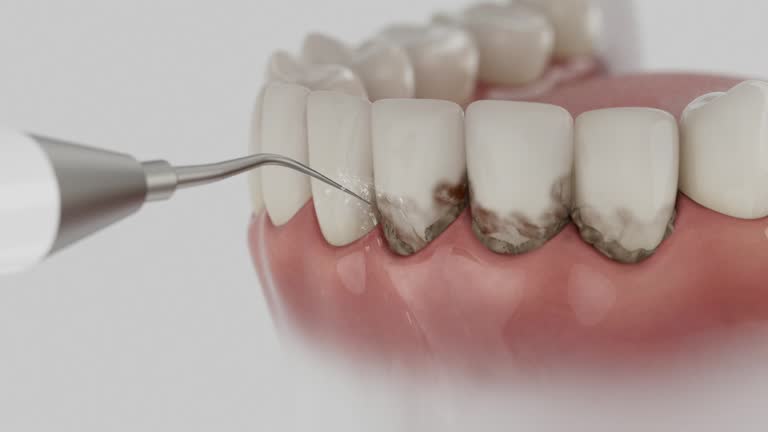 Reliable Tooth Extraction contractor in Marble Falls, TX by Smile Center Dentistry